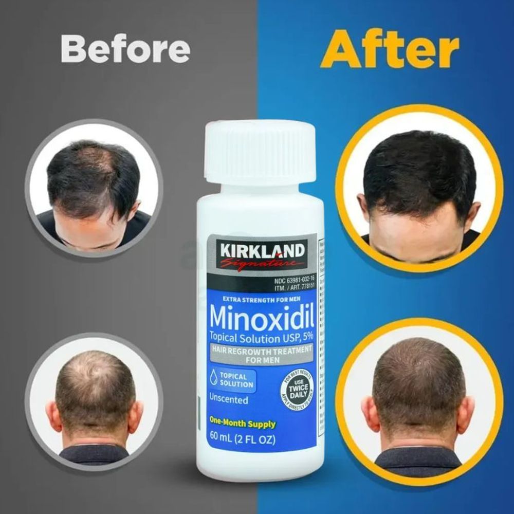 Kirkland 5% Minoxidil Extra Strength Hair Loss & Hair Regrowth Treatment for Men 60ml  