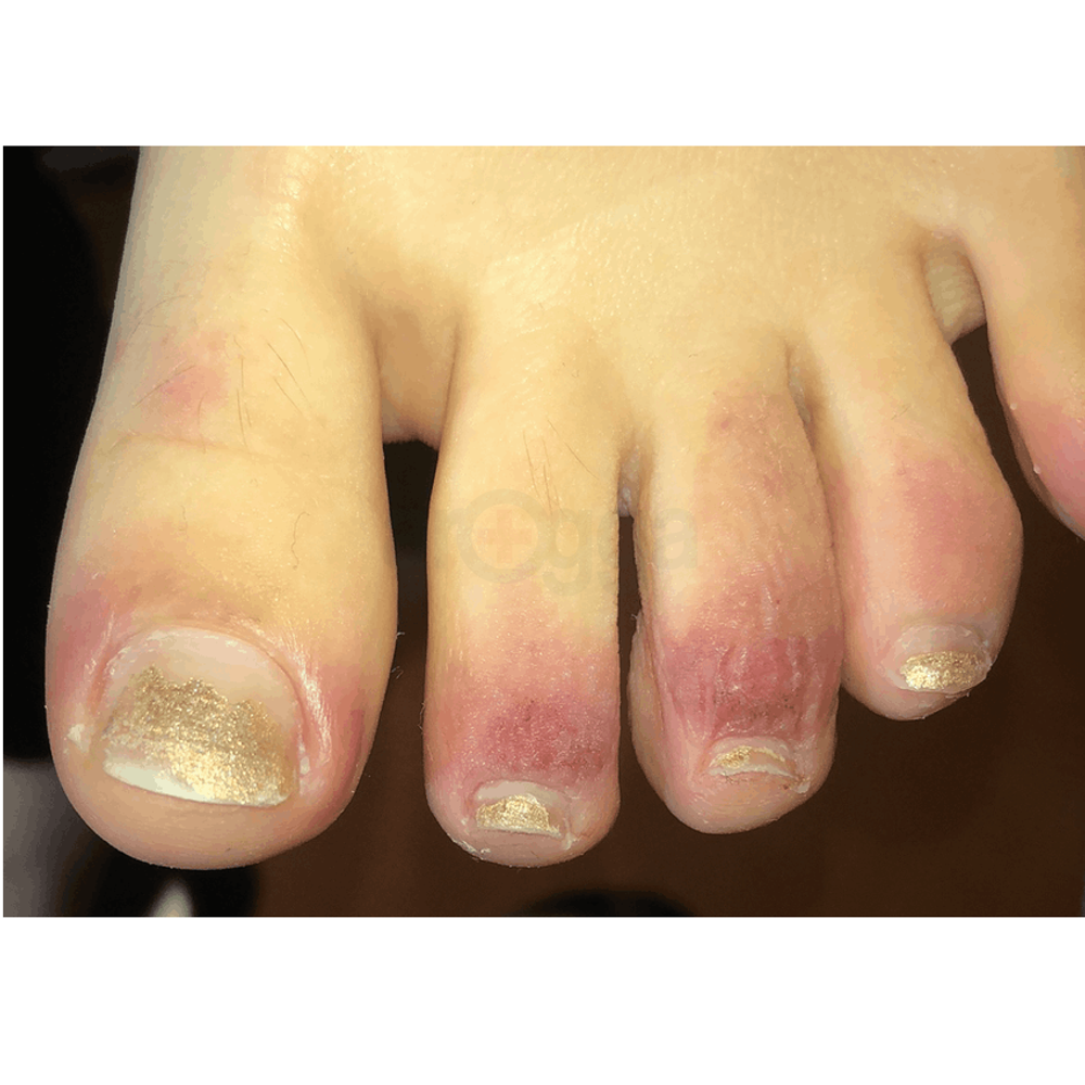 Dont active (Melacare Hydroquinone Tretinoin Mometasone Furoate Cream)  