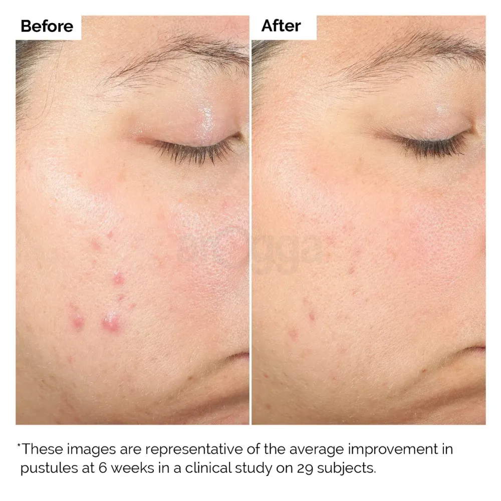 The Ordinary Salicylic Acid 2% Solution for Acne Prone Skin  