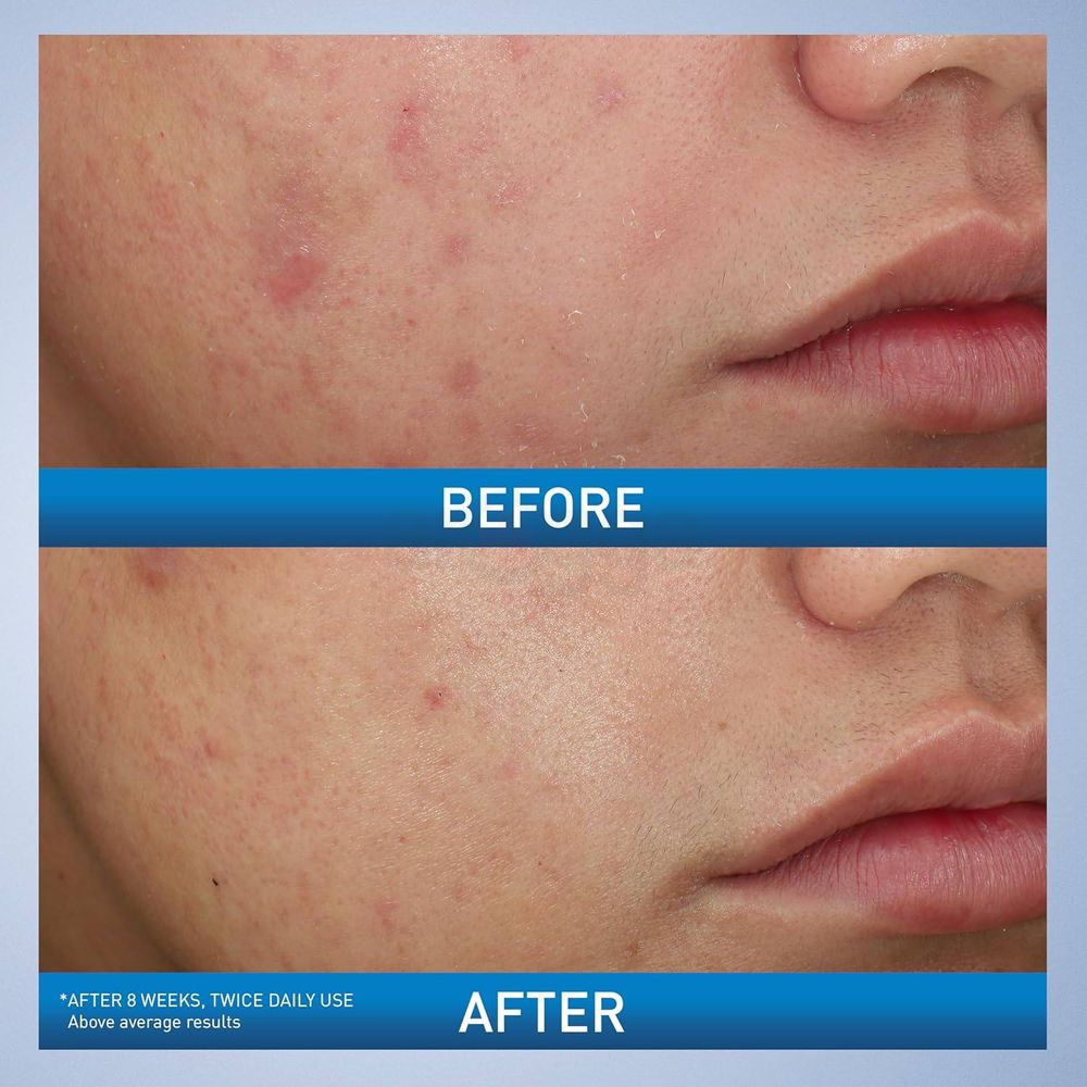 Cerave Acne Foaming Cream Wash 10% Benzoyl Peroxide for Acne Treatment (Made in USA)  150ml  