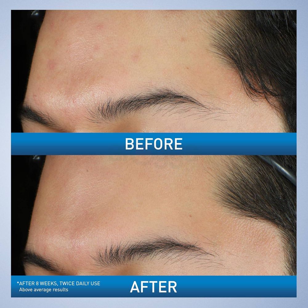 Cerave Acne Foaming Cream Wash 10% Benzoyl Peroxide for Acne Treatment (Made in USA)  150ml  