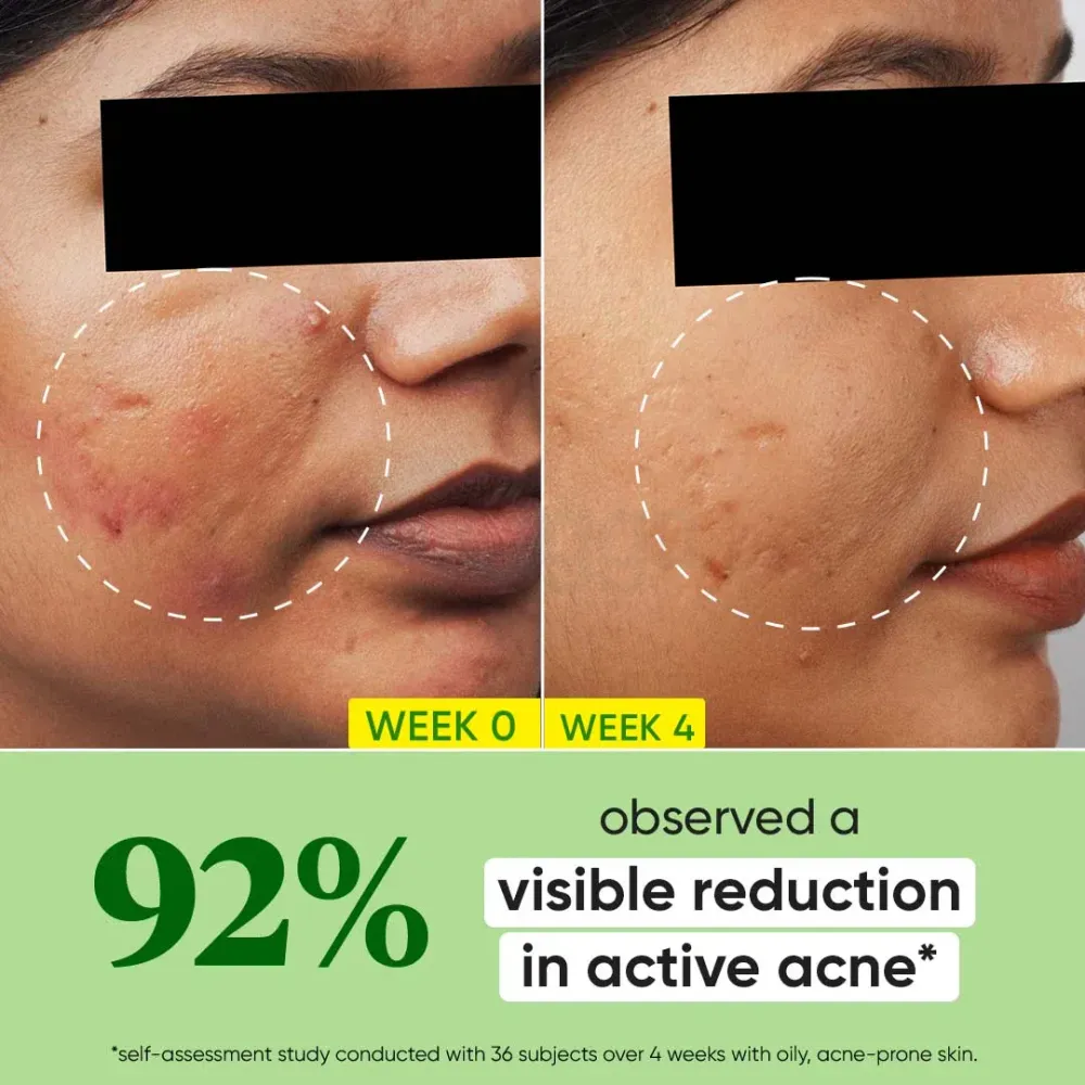 Dot and Key Cica + 2% Salicylic Acne and Oil Control Skin Clearing Face Serum with Zinc and Cactus Water  