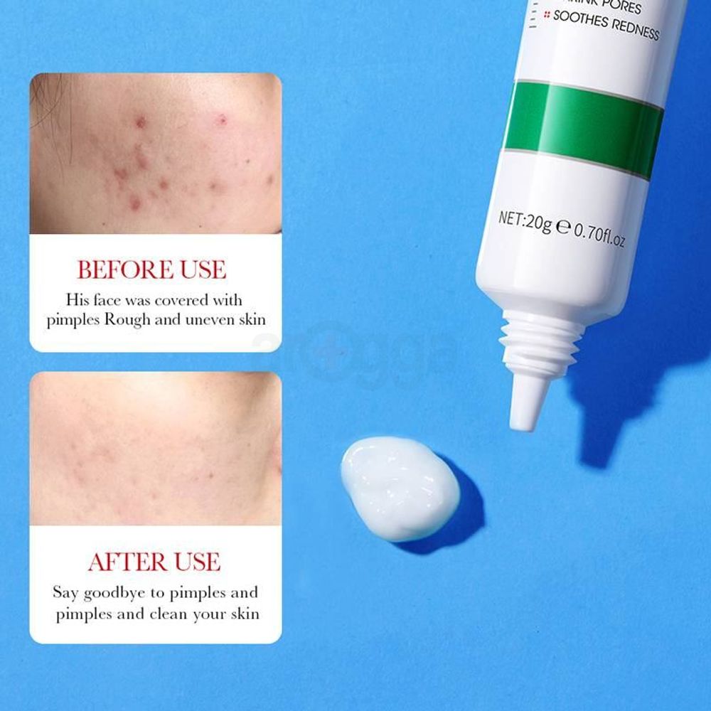 Bioaqua Salicylic Acid Acne Removal Cream - 20g  