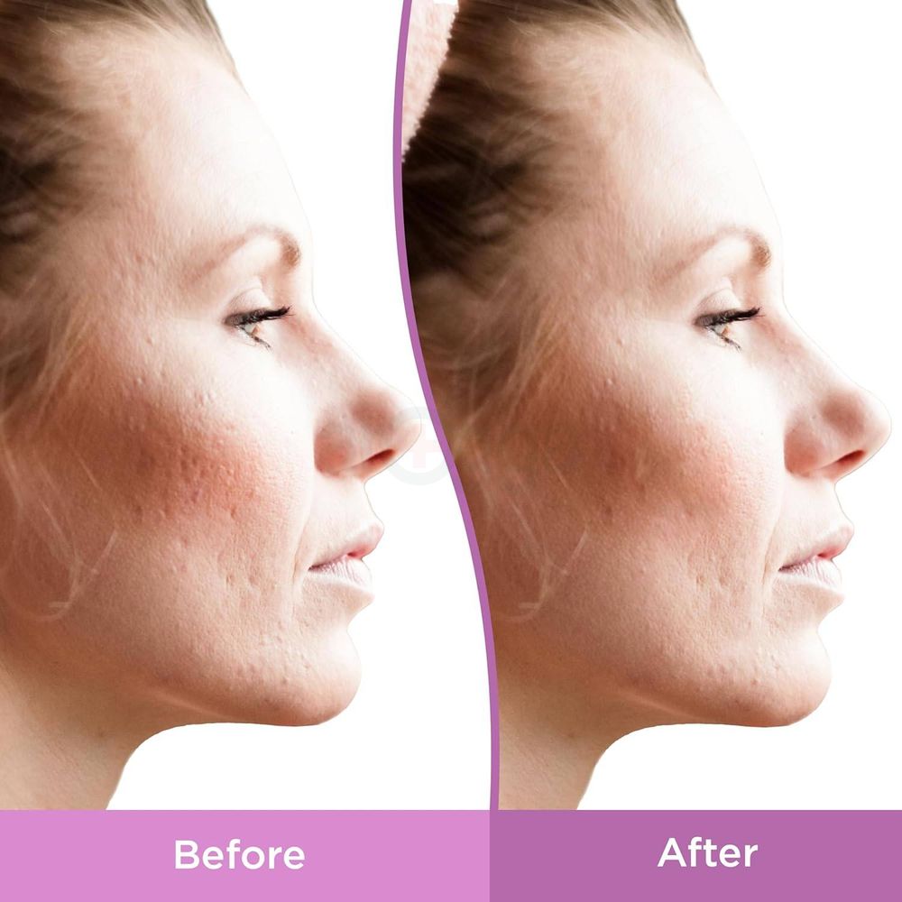 Differin Repair Resurfacing Scar Gel  