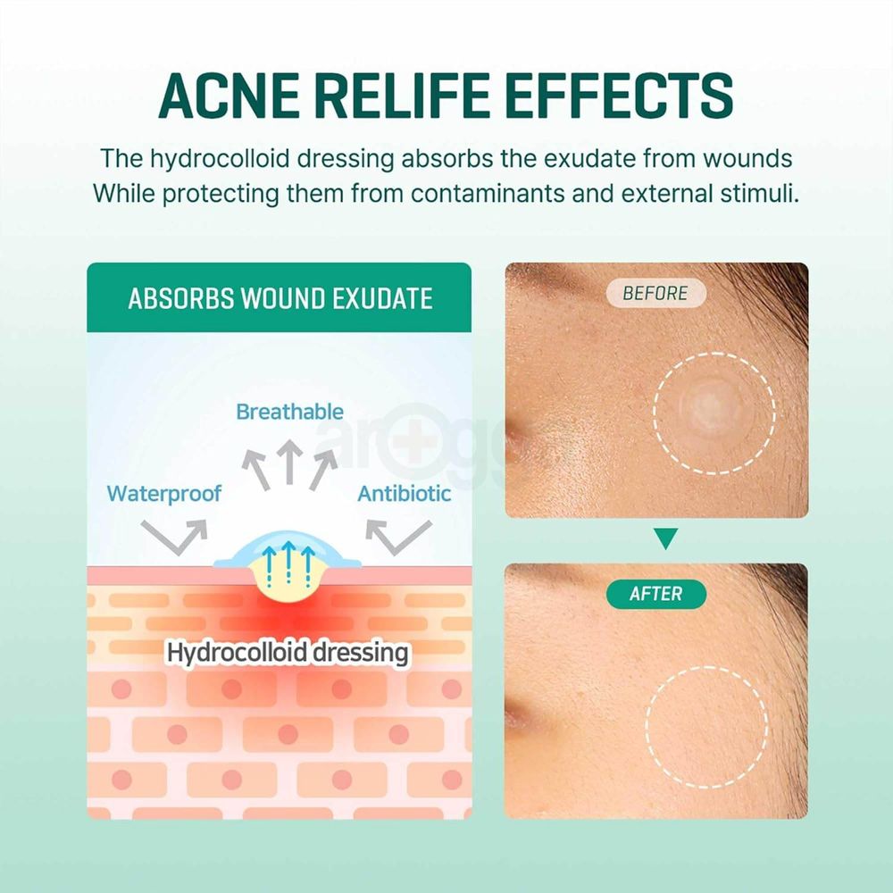 Some By Mi Clear Spot Patch  - 18 Patches  