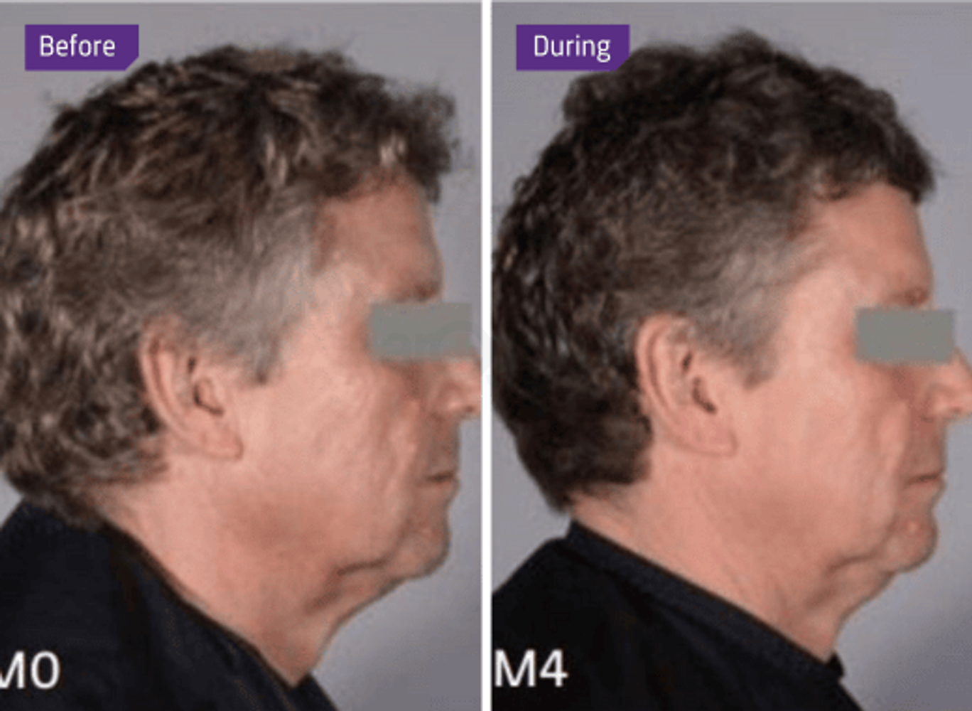 Before and after Anti Grey (2).png__PID:5572bccd-f86b-4723-89c7-fe19d7db541e